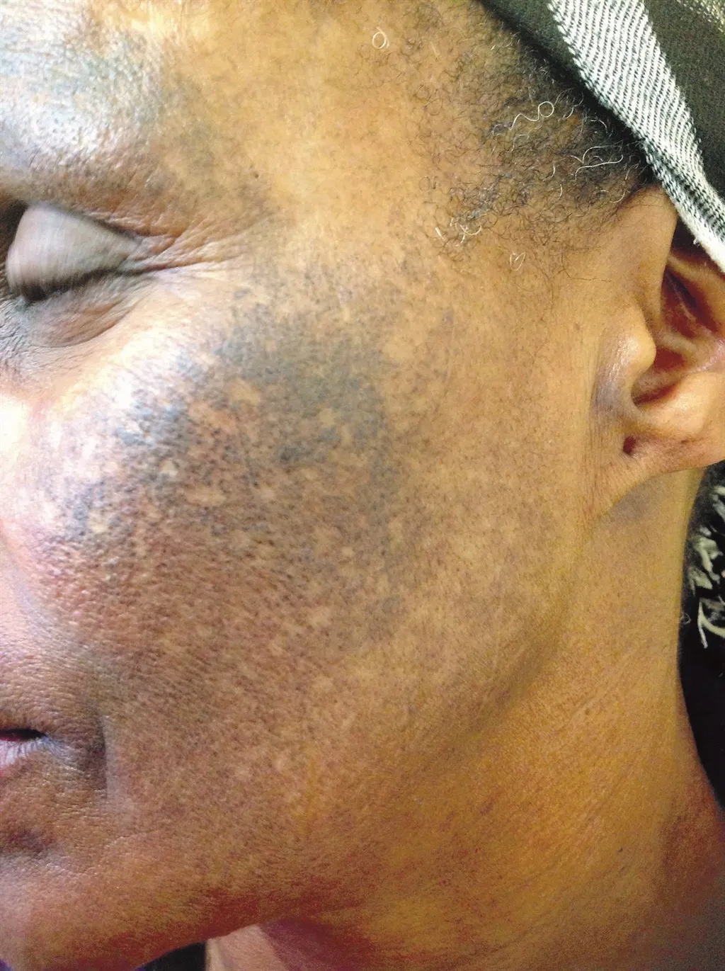 29552 bacterial fungal infections