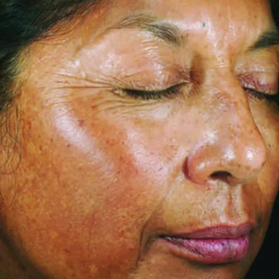 29552 skin cancer awareness