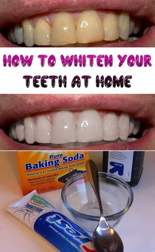 29553 teeth whitening at home