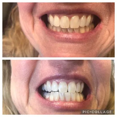 29554 spokane teeth whitening options