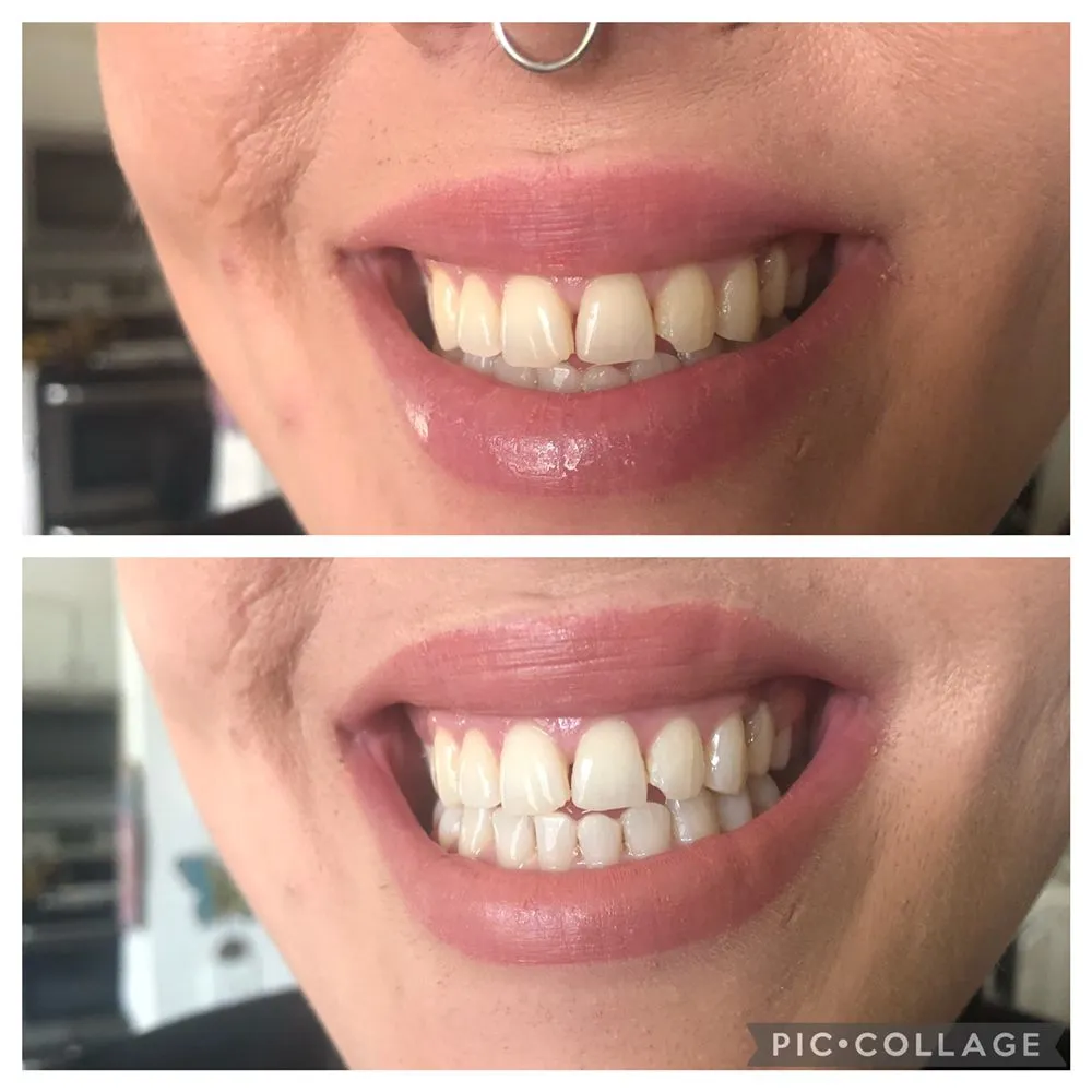 29554 teeth whitening spokane before after