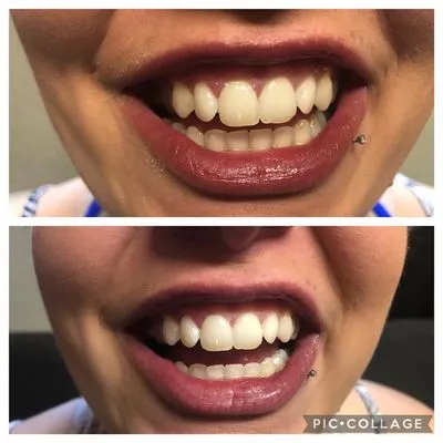 29554 teeth whitening spokane confidence