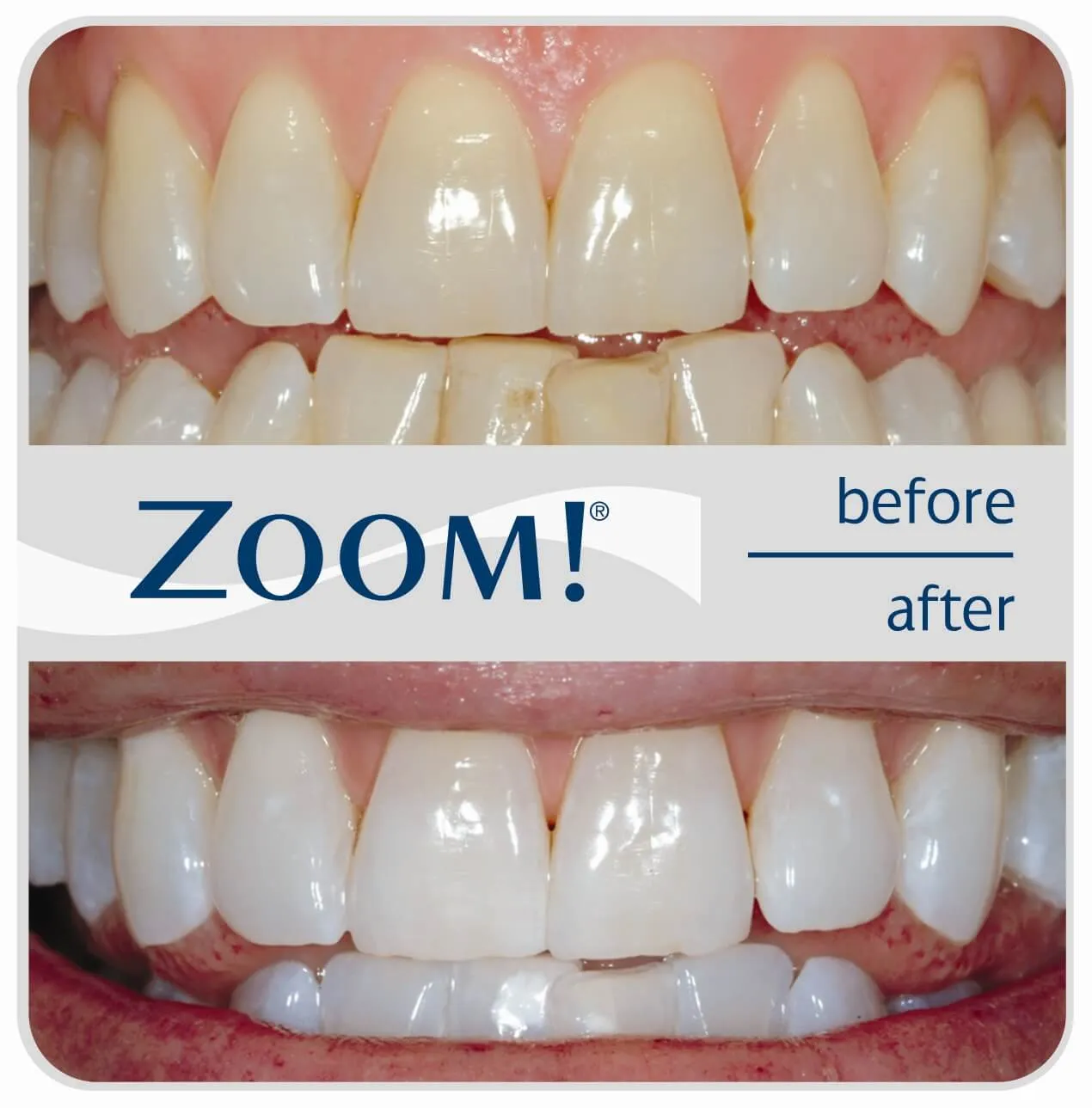 29559 zoom 2 whitening smile