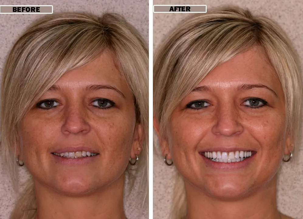 29568 laser teeth whitening care