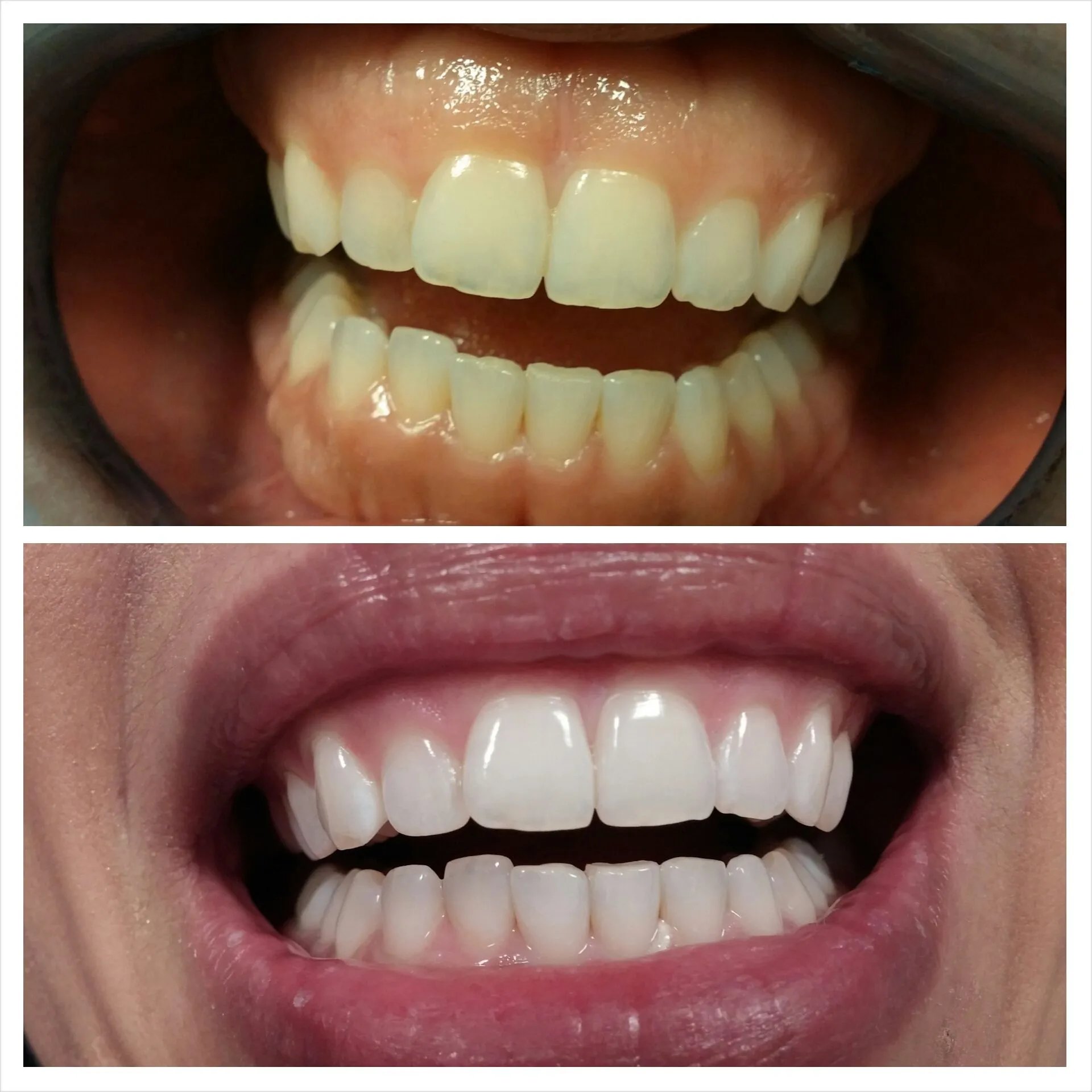 29568 laser teeth whitening cost