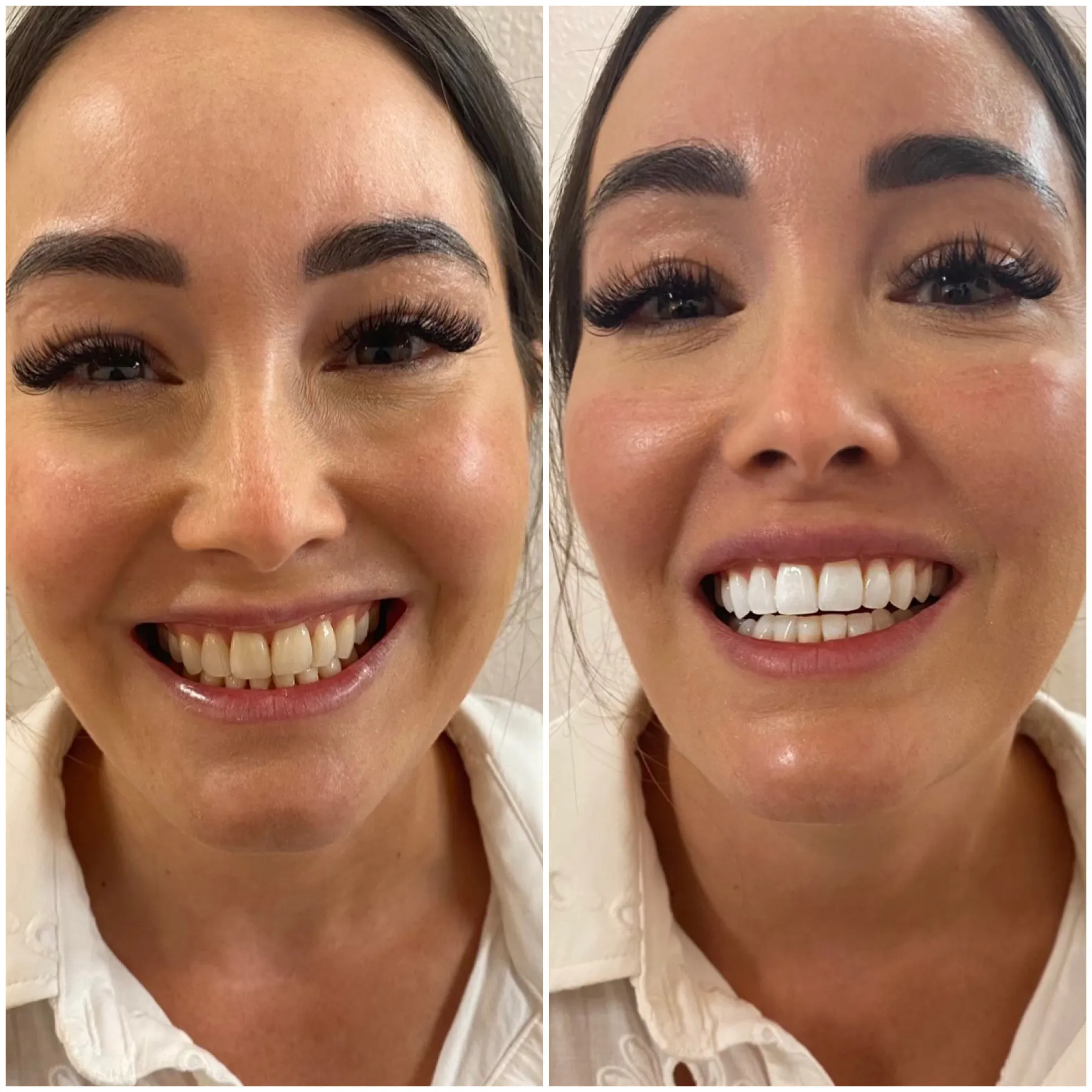 29568 laser teeth whitening results