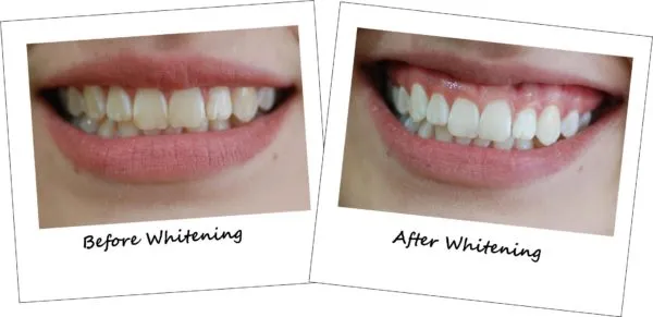 /img/29568-teeth-whitening-smile.webp