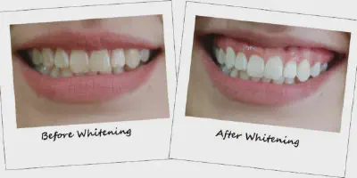/img/29568-teeth-whitening-smile.webp