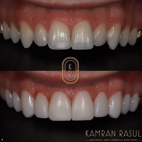 29571 in office teeth whitening