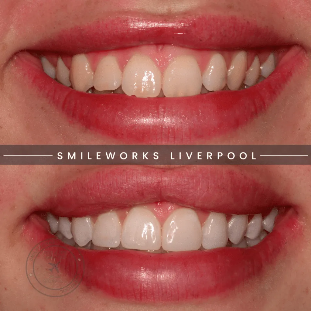 29571 teeth whitening liverpool 1