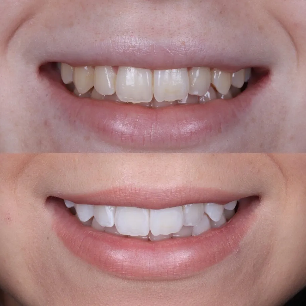 29574 teeth whitening liverpool cost