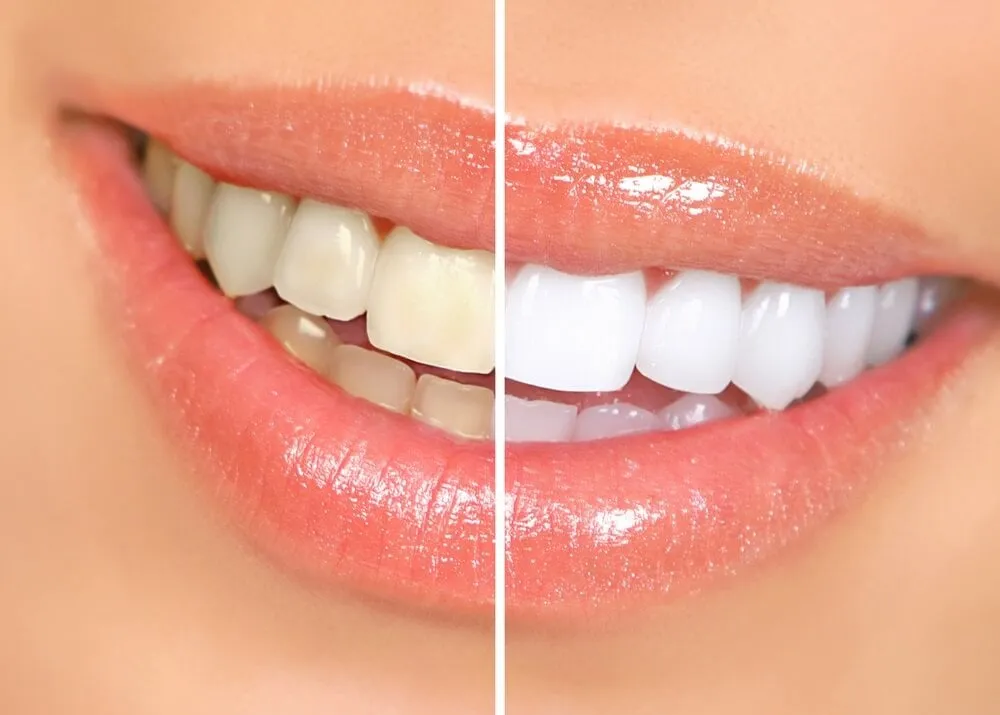 /img/29574-teeth-whitening-liverpool-dentist.webp