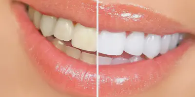 /img/29574-teeth-whitening-liverpool-dentist.webp