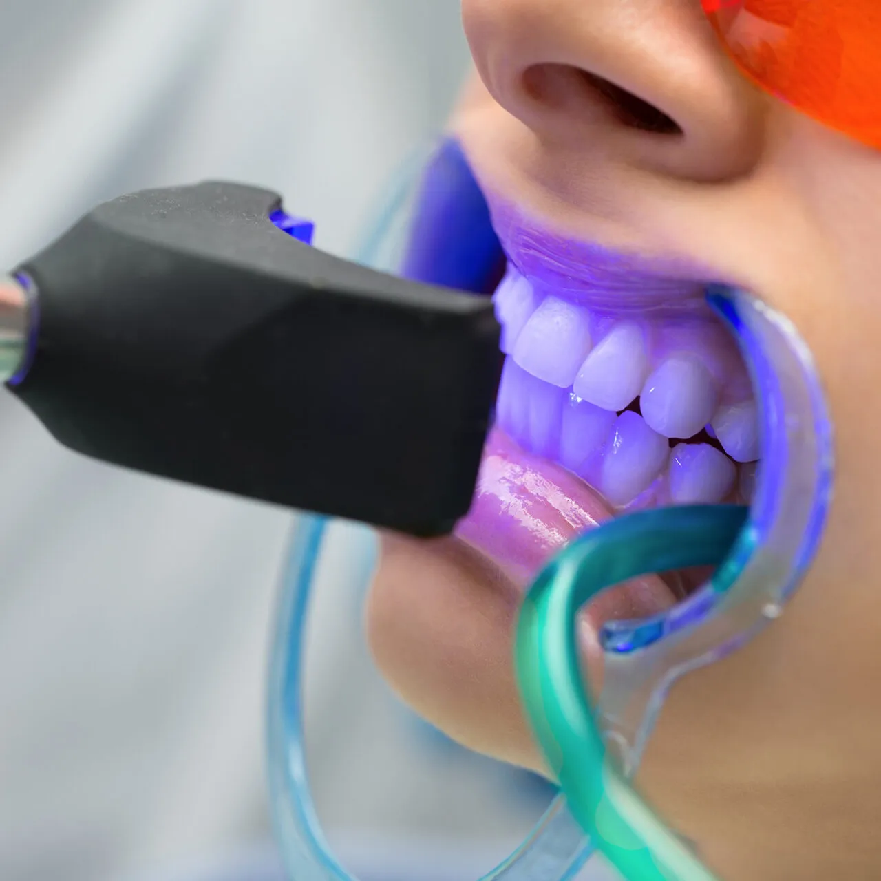 29574 teeth whitening liverpool types