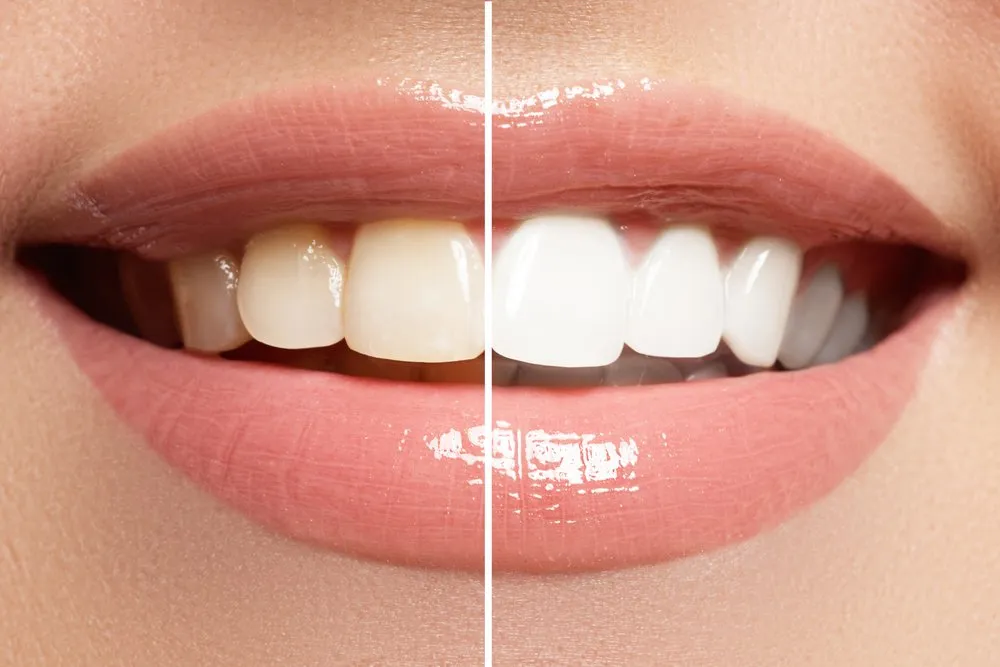 29575 teeth whitening portland me 1