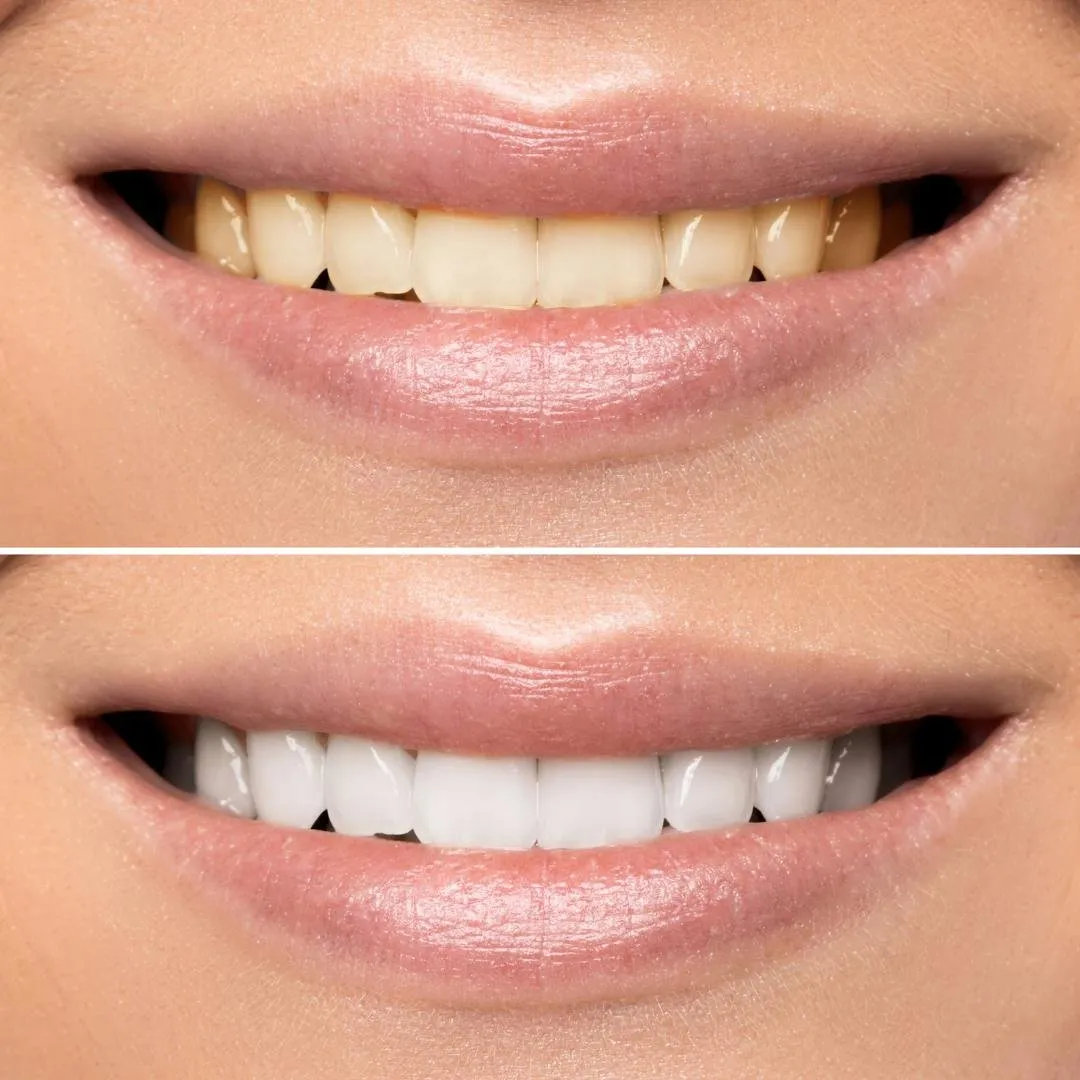 29575 teeth whitening portland me 3