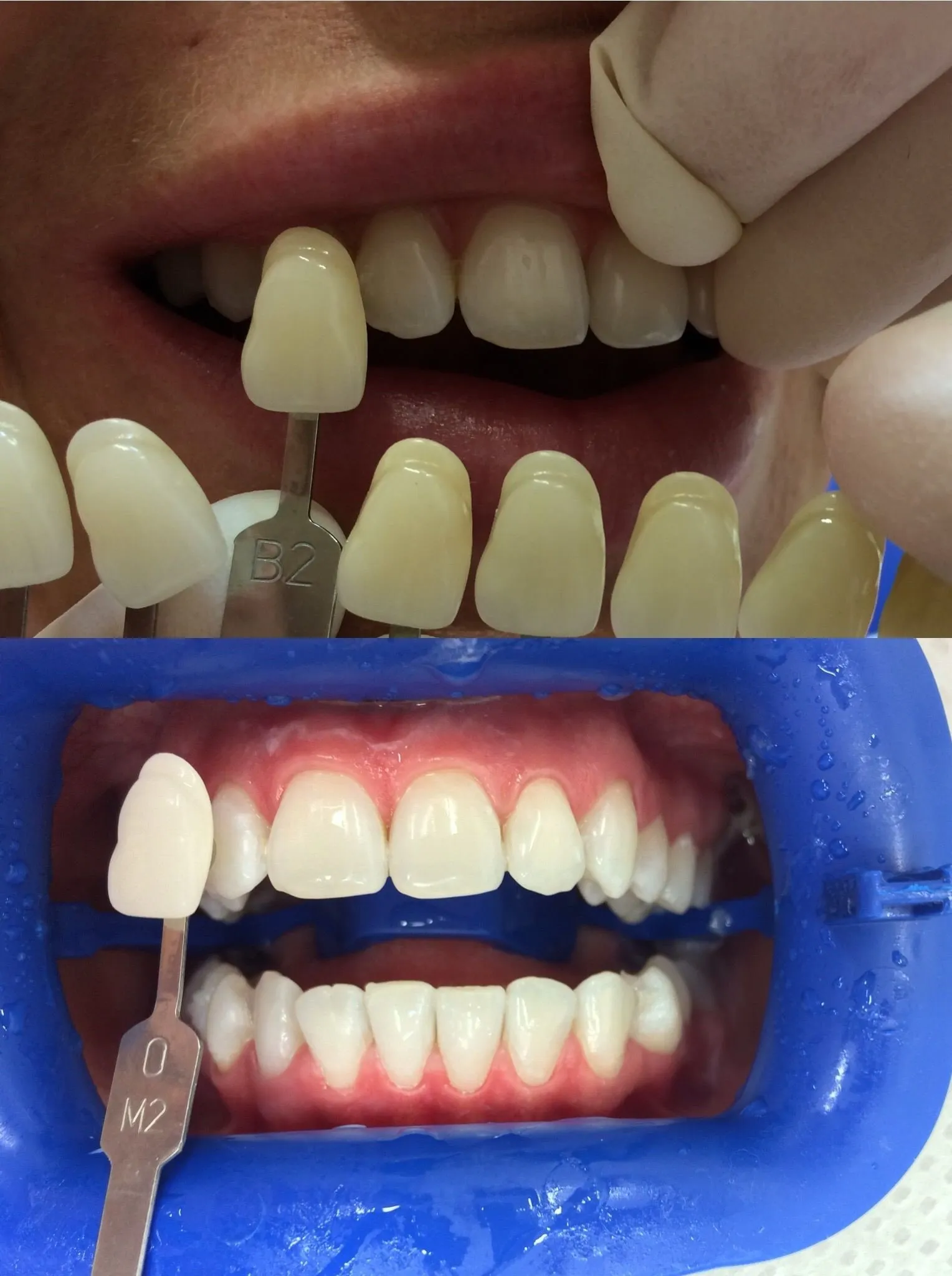 29576 at home teeth whitening