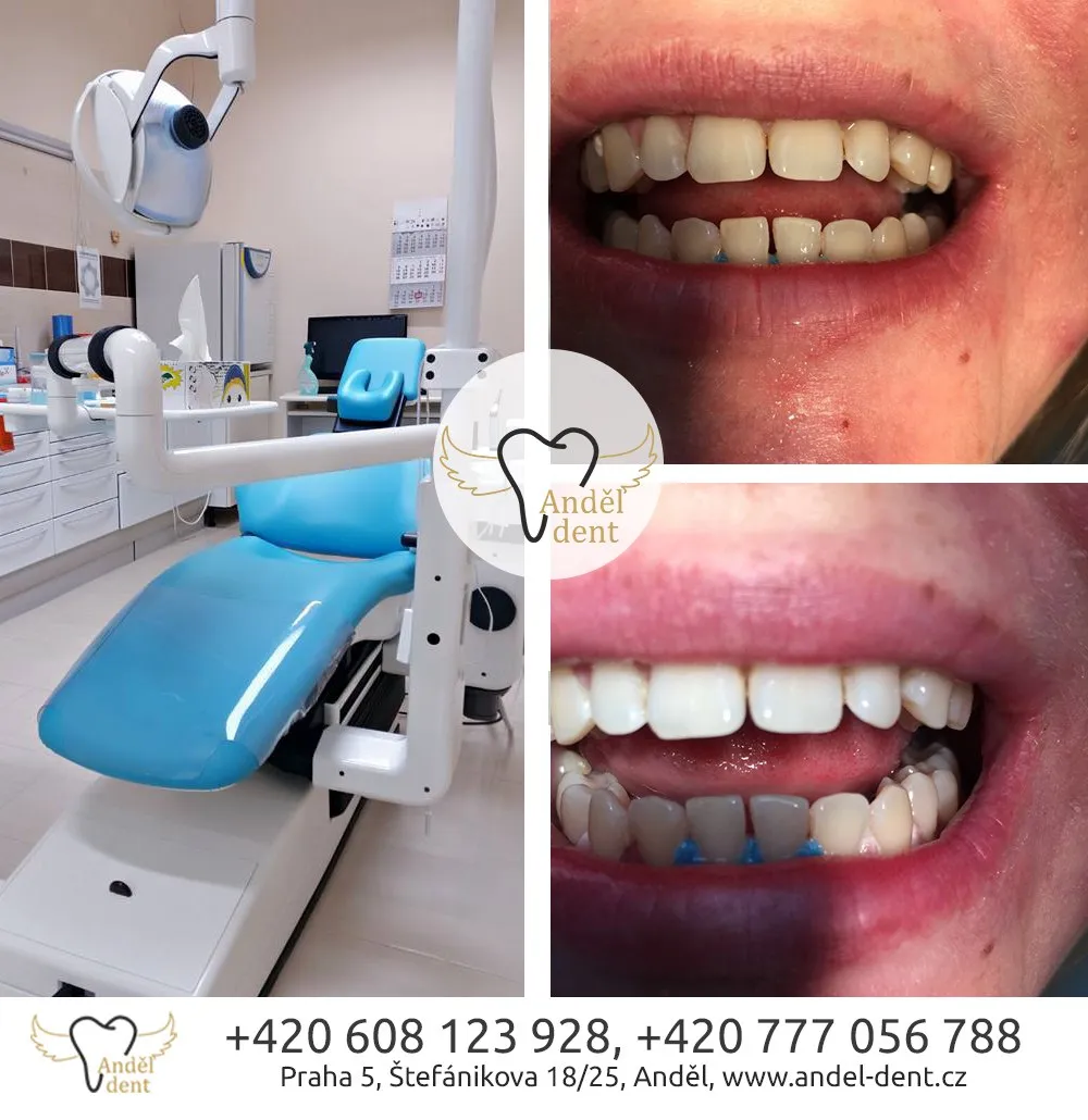 29576 teeth whitening prague aftercare