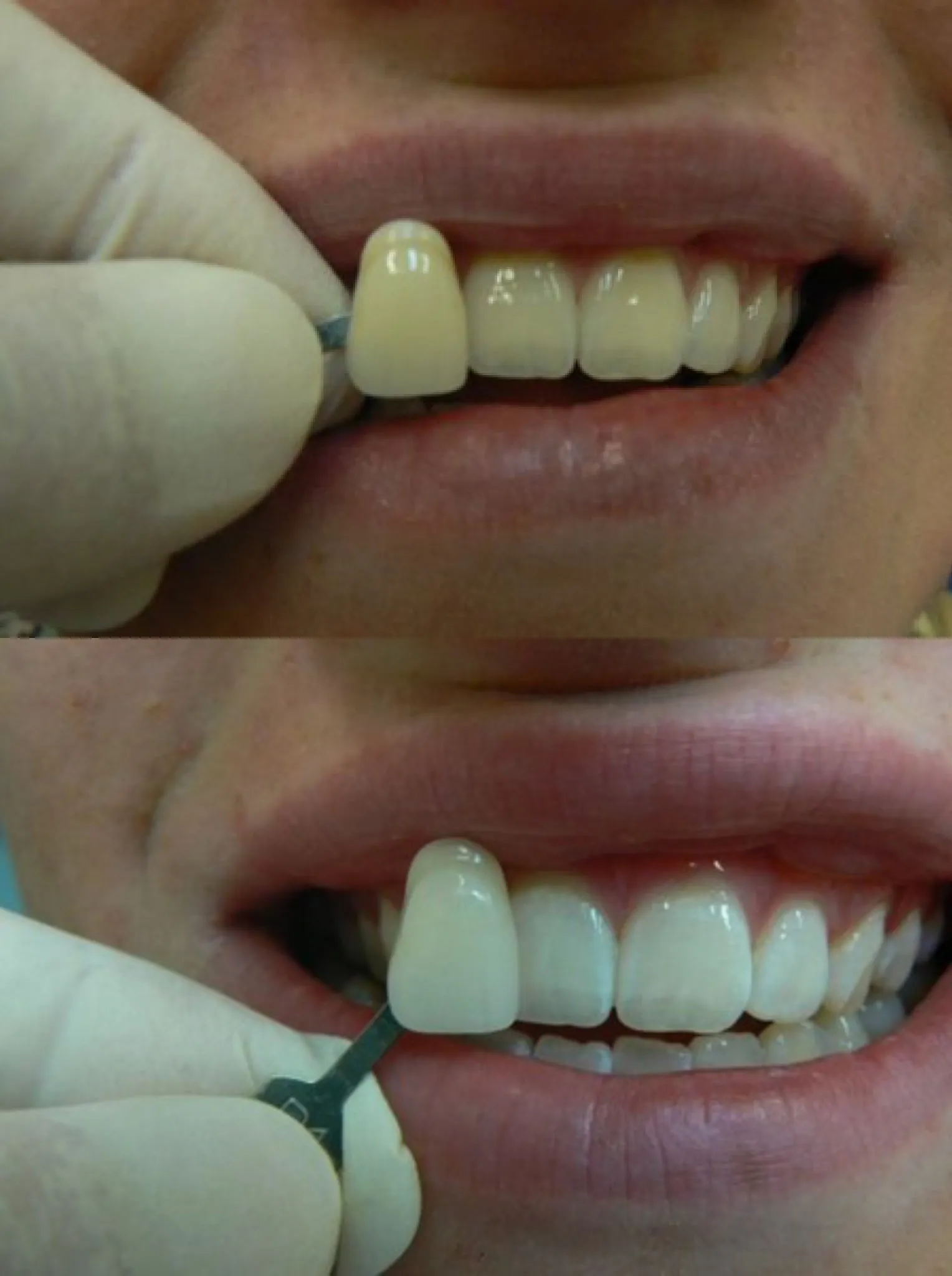 29576 teeth whitening prague clinic