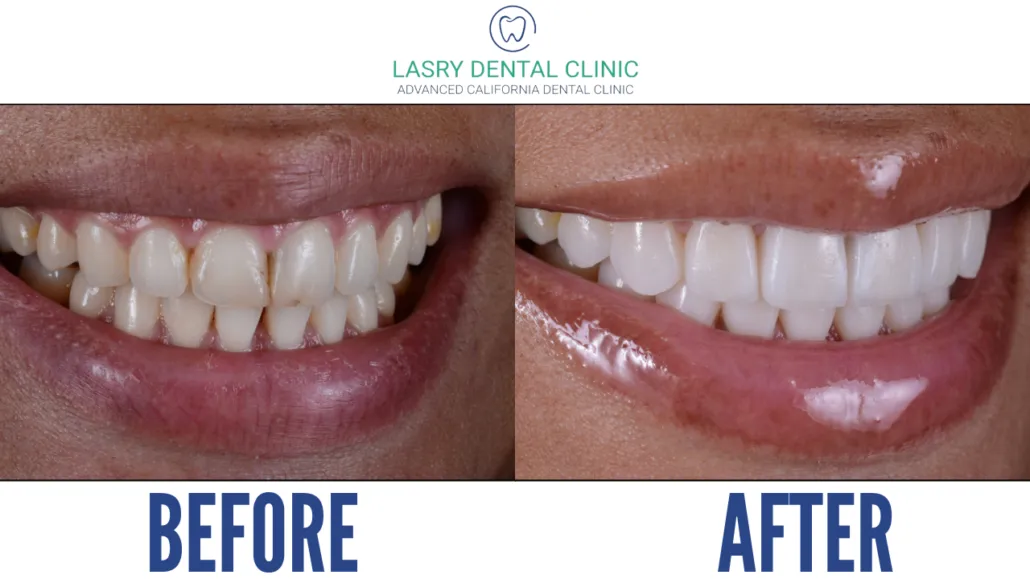 29577 teeth whitening results patient