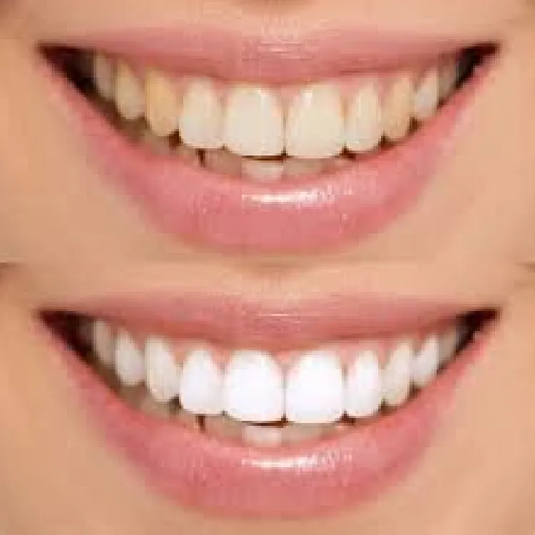 29580 teeth whitening surprise az 3