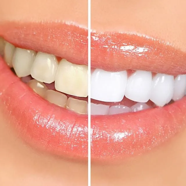 29580 teeth whitening surprise az 6