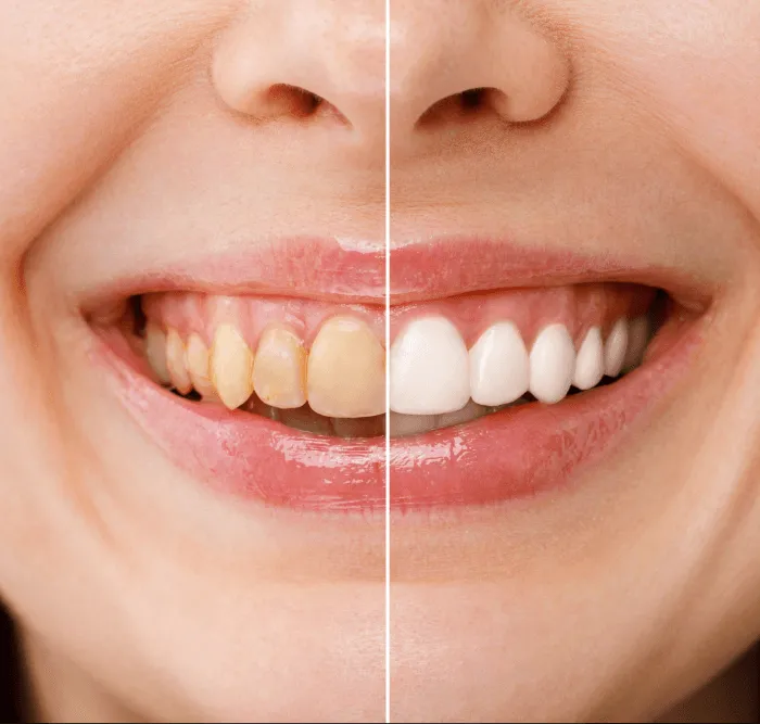 29583 teeth whitening sf image2