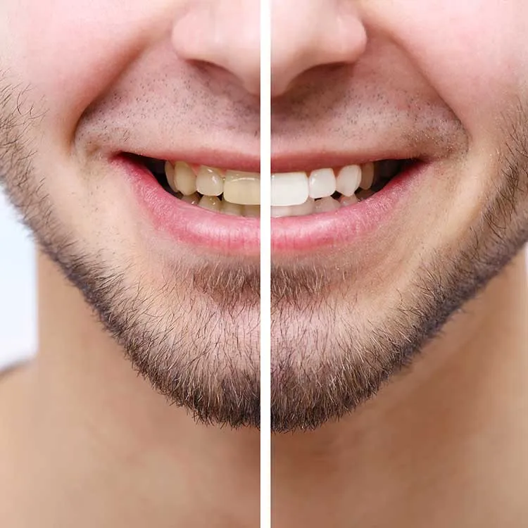 29583 teeth whitening sf image5