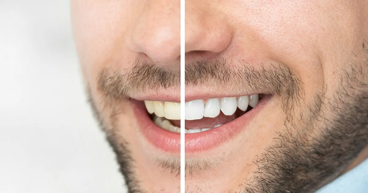 /img/29583-teeth-whitening-sf-image7.webp
