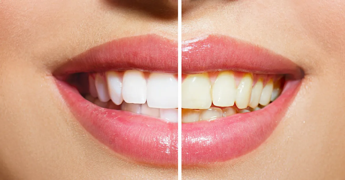 29585 laser teeth whitening results