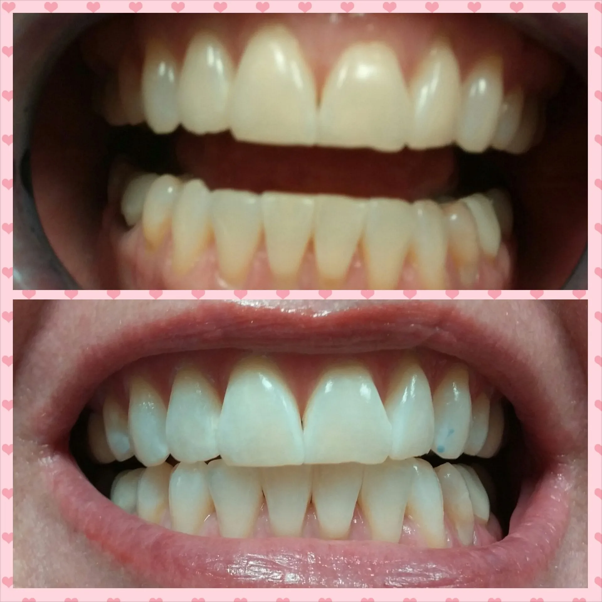 29585 teeth whitening maintenance