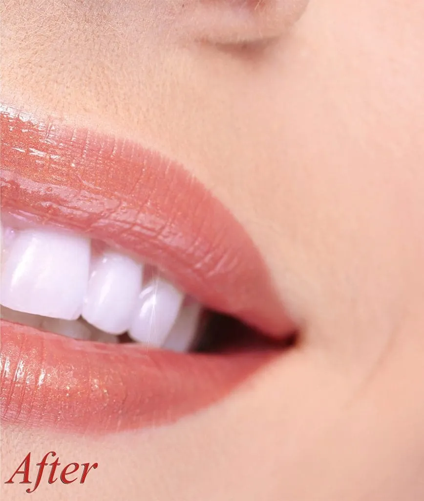 29589 flower mound teeth whitening options