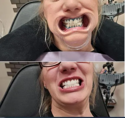 29589 in office teeth whitening