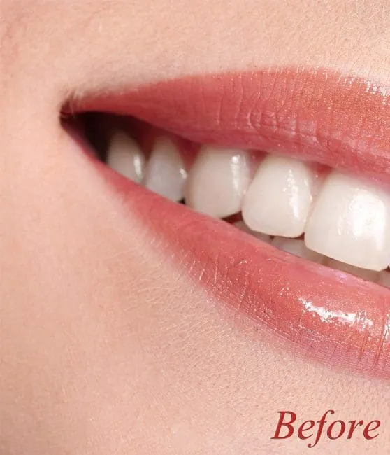 /img/29589-teeth-whitening-cost-factors.webp