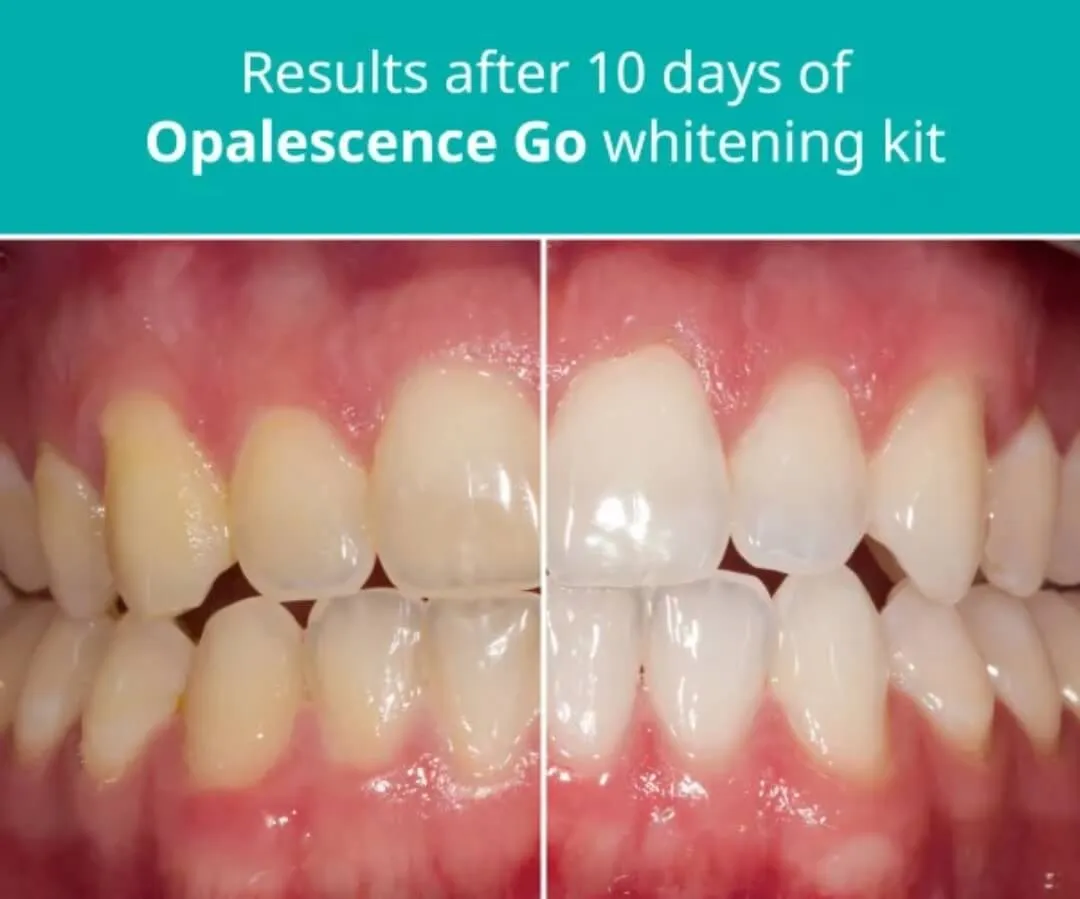 29589 teeth whitening science