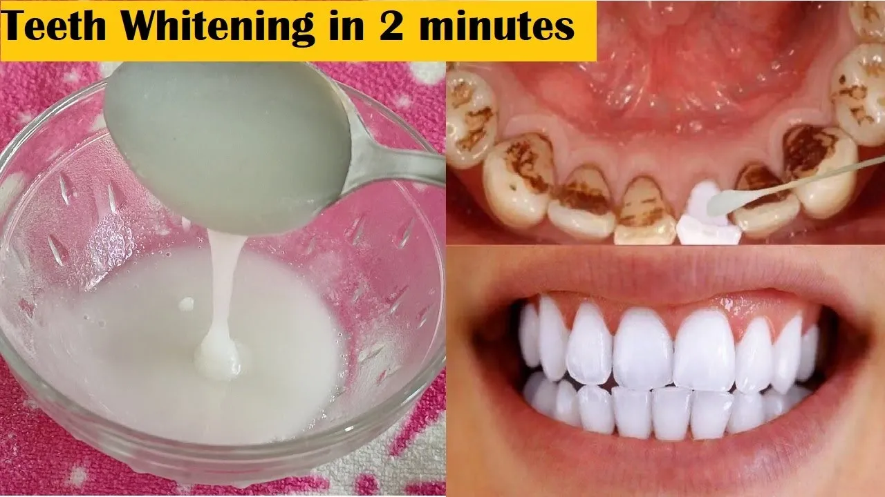 29596 dental sealants