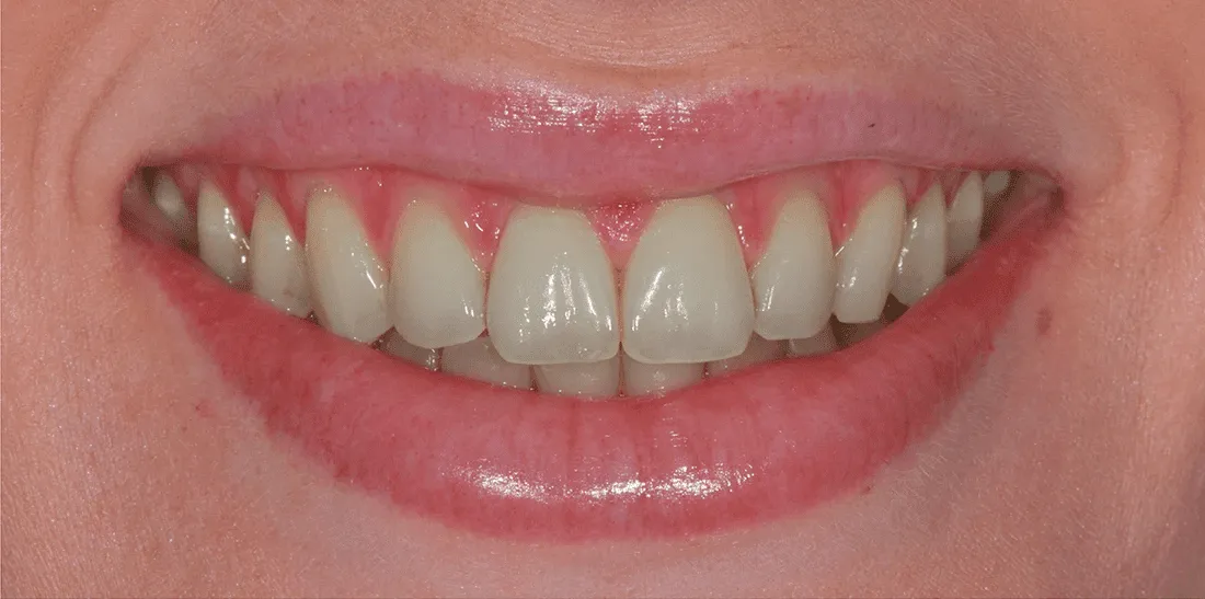 29597 teeth whitening rochester ny custom trays