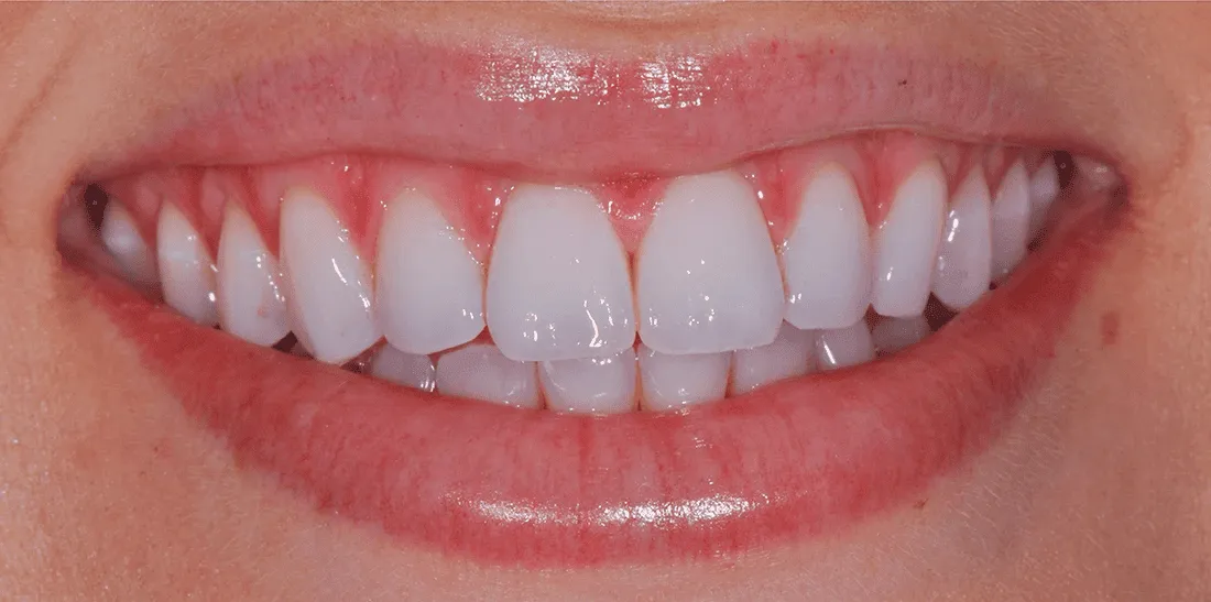 29597 teeth whitening rochester ny dentist consultation