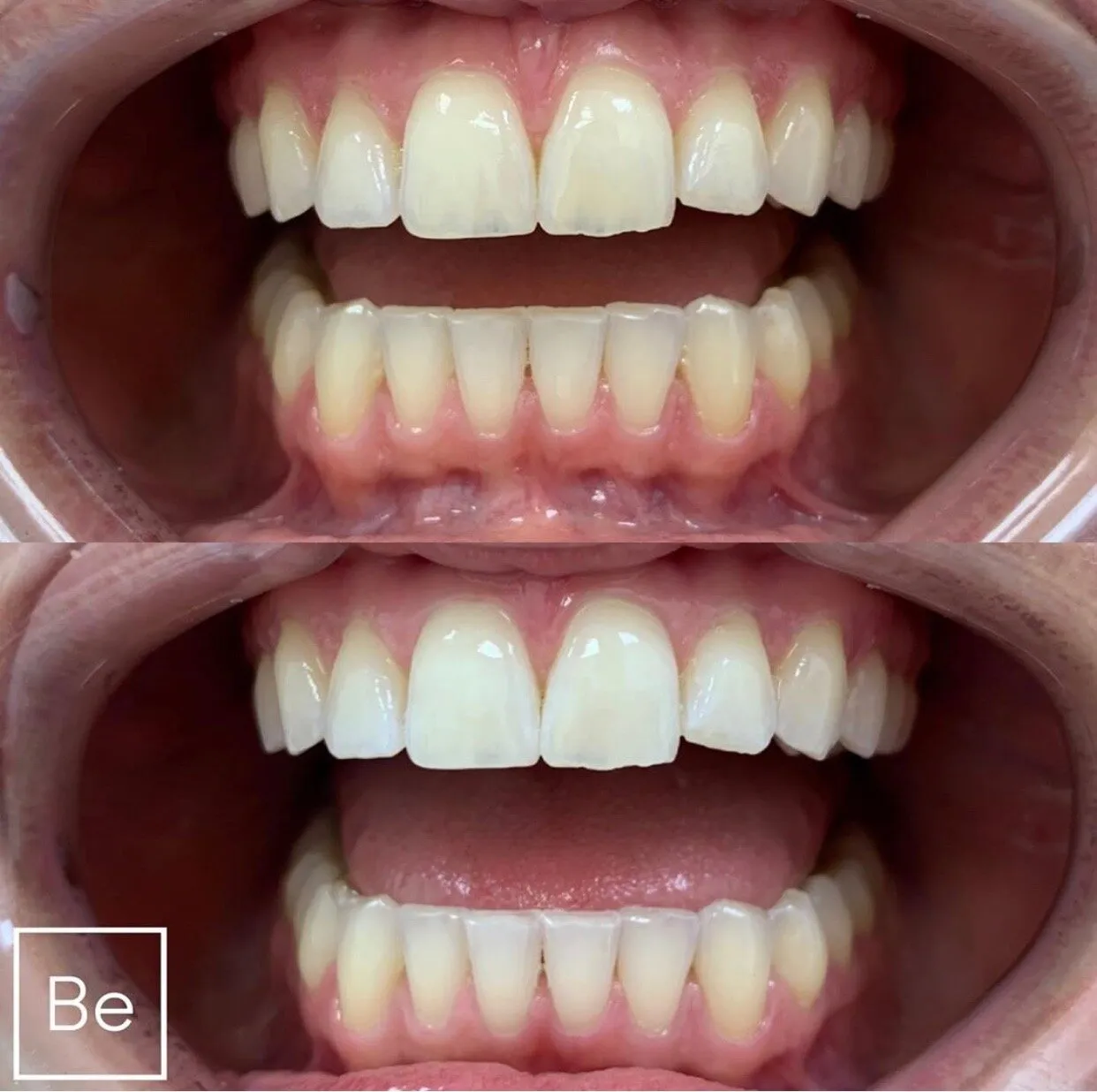 29597 teeth whitening rochester ny in office