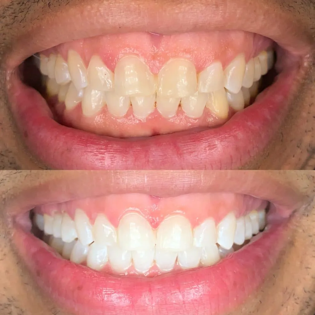 29601 core teeth whitening comparison