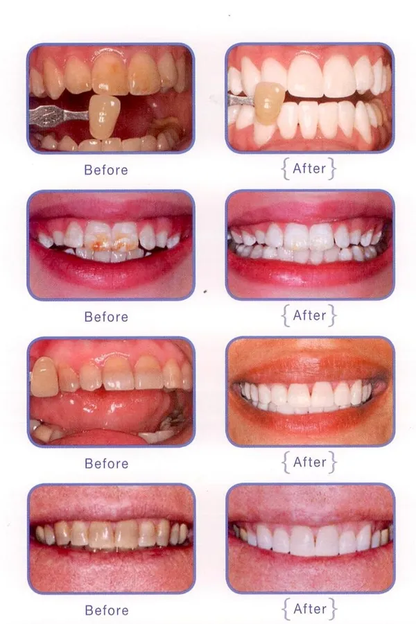 29601 core teeth whitening procedure