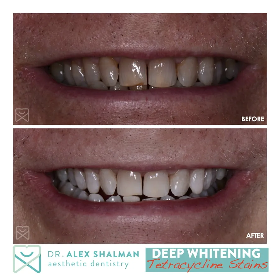 29601 core teeth whitening smile