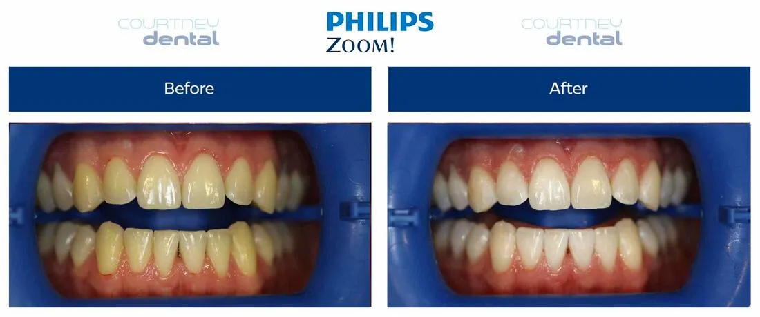29602 dehydration during whitening