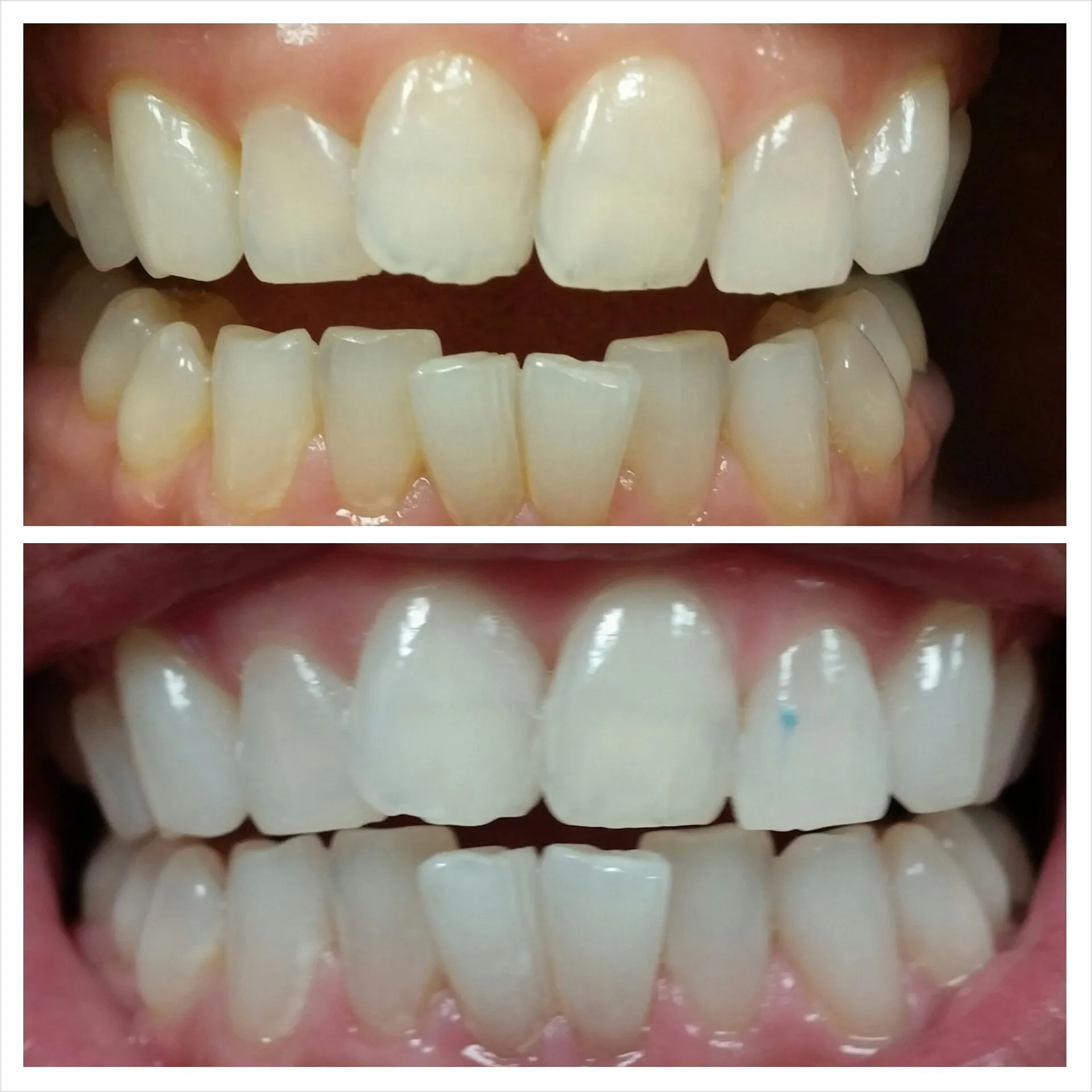 /img/29605-teeth-whitening-laser-alternatives.webp