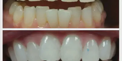 /img/29605-teeth-whitening-laser-alternatives.webp