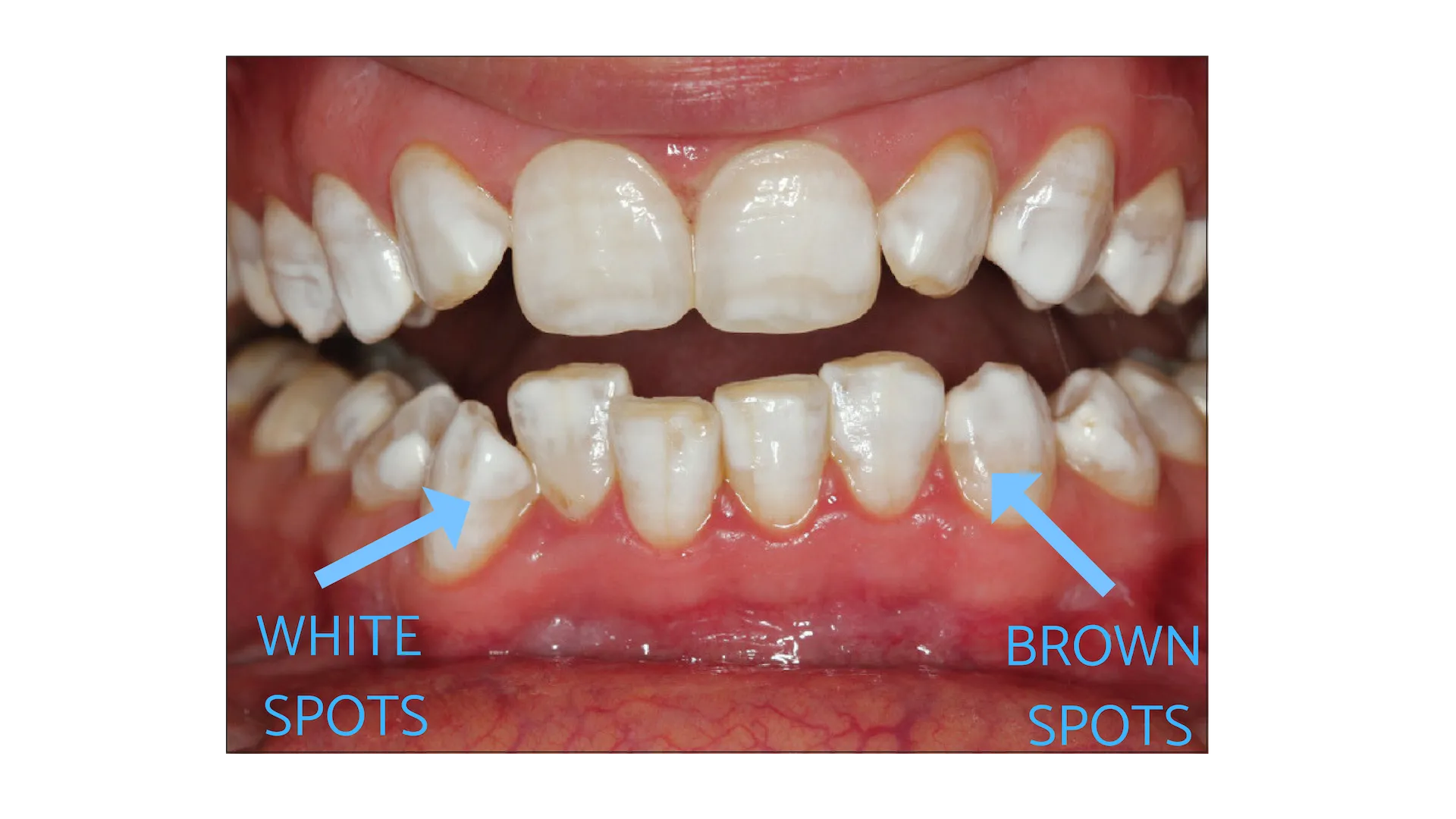 29608 at home whitening