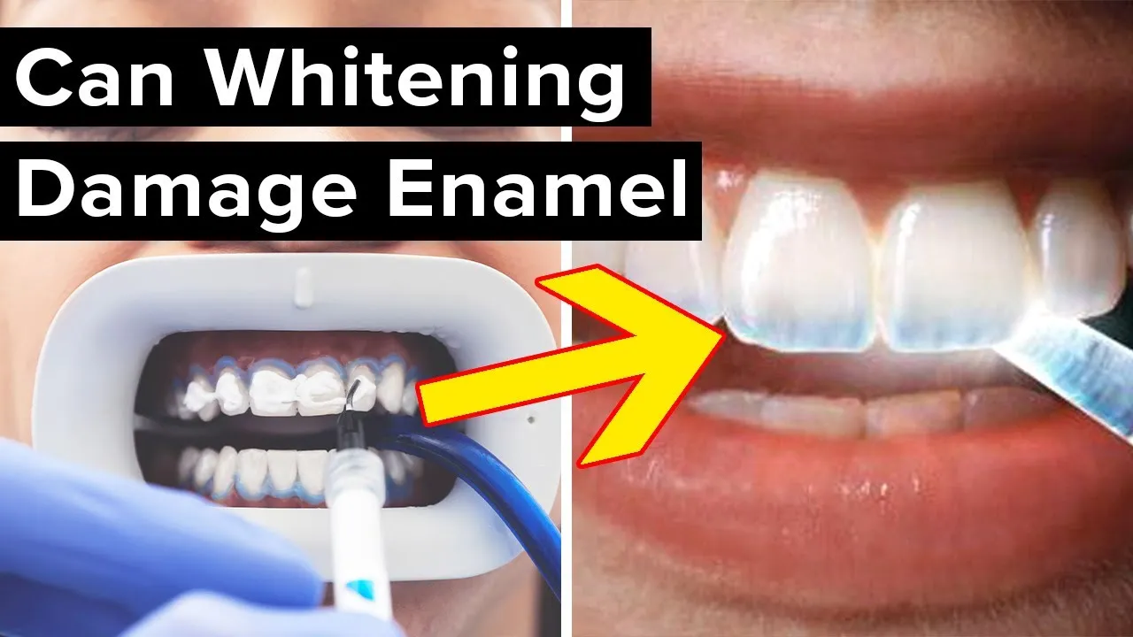 29608 in office whitening