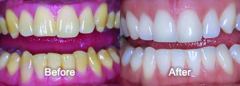 29610 at home teeth whitening kits