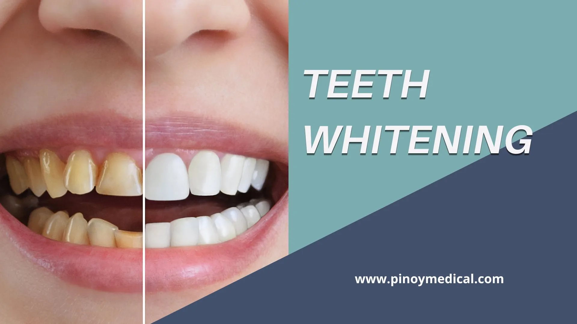 29620 teeth whitening philippines laser