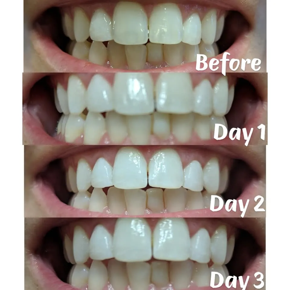 29622 teeth whitening results